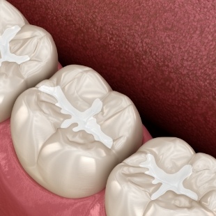 Animated row of teeth with dental sealants