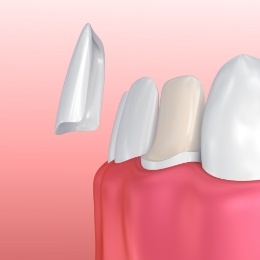 Animated dental veneer being placed over the front of a tooth