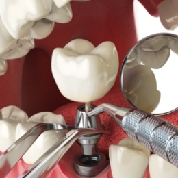 Animated dental implant being placed in the lower jaw