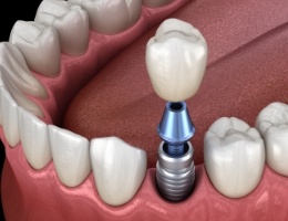 Animated dental implant with dental crown