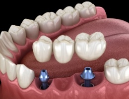 Animated dental bridge supported by two dental implants