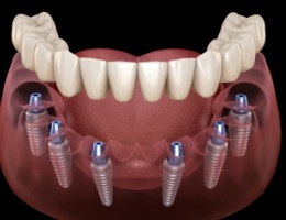 Animated implant denture supported by six dental implants