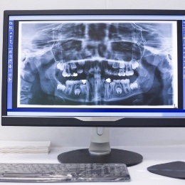 Digital x rays of teeth on computer screen