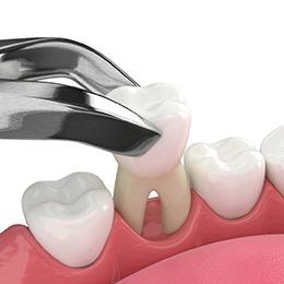 Illustration of a tooth being removed