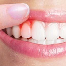 Close up of person pointing to red area of inflammation in their gums