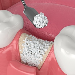 Digital illustration of a bone graft