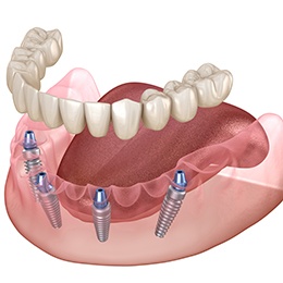 Illustration of implant dentures in Nepean, ON