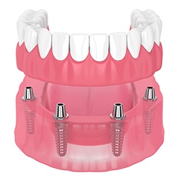 Illustration of denture being attached to four dental implants