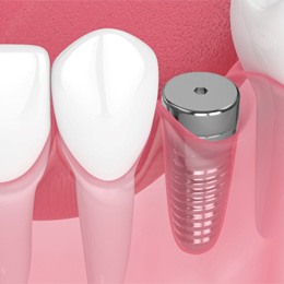 Digital illustration of a dental implant