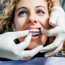 Dentist placing Invisalign aligner in patient's mouth