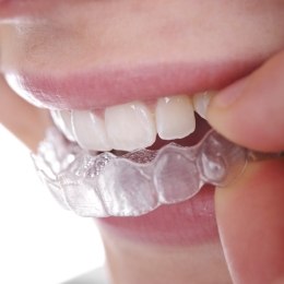 Close up of a person placing an Invisalign clear aligner in their mouth