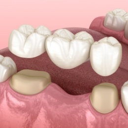 Animated dental bridge replacing a missing tooth