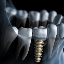 Animated X ray of a person with a dental implant