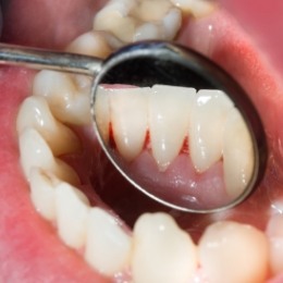 Close up of dental mirror inside of mouth