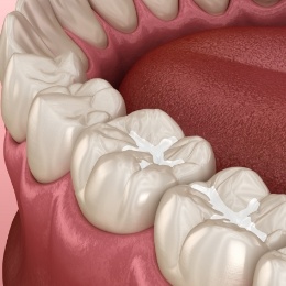 Animated row of teeth with tooth coloured fillings