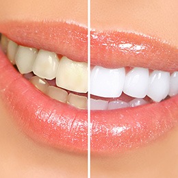 Closeup of patient's smile before and after teeth whitening