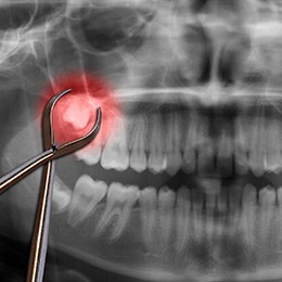 Dental forceps laying over an x-ray depicting wisdom teeth