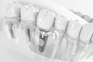 Shiny white 3D image of a dental implant