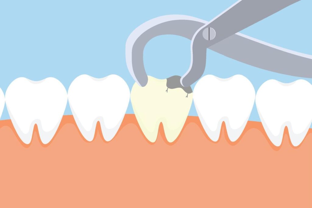close-up illustration of a tooth extraction
