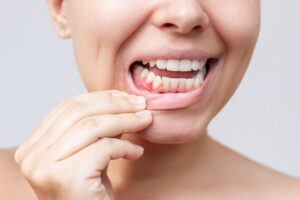 Person showing bumps on their gums.