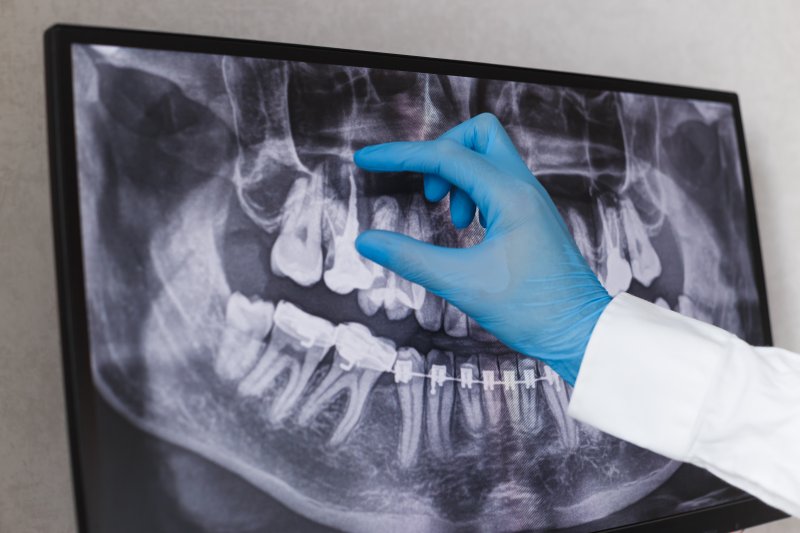 Dentist showing wisdom teeth in X-ray